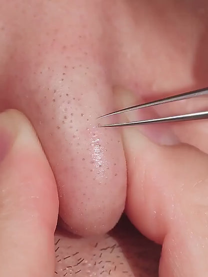 ClearSkin™ – Stainless Steel Blackhead Removal Kit